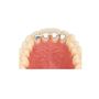 Retainer horní LAT/LAT 14 mm